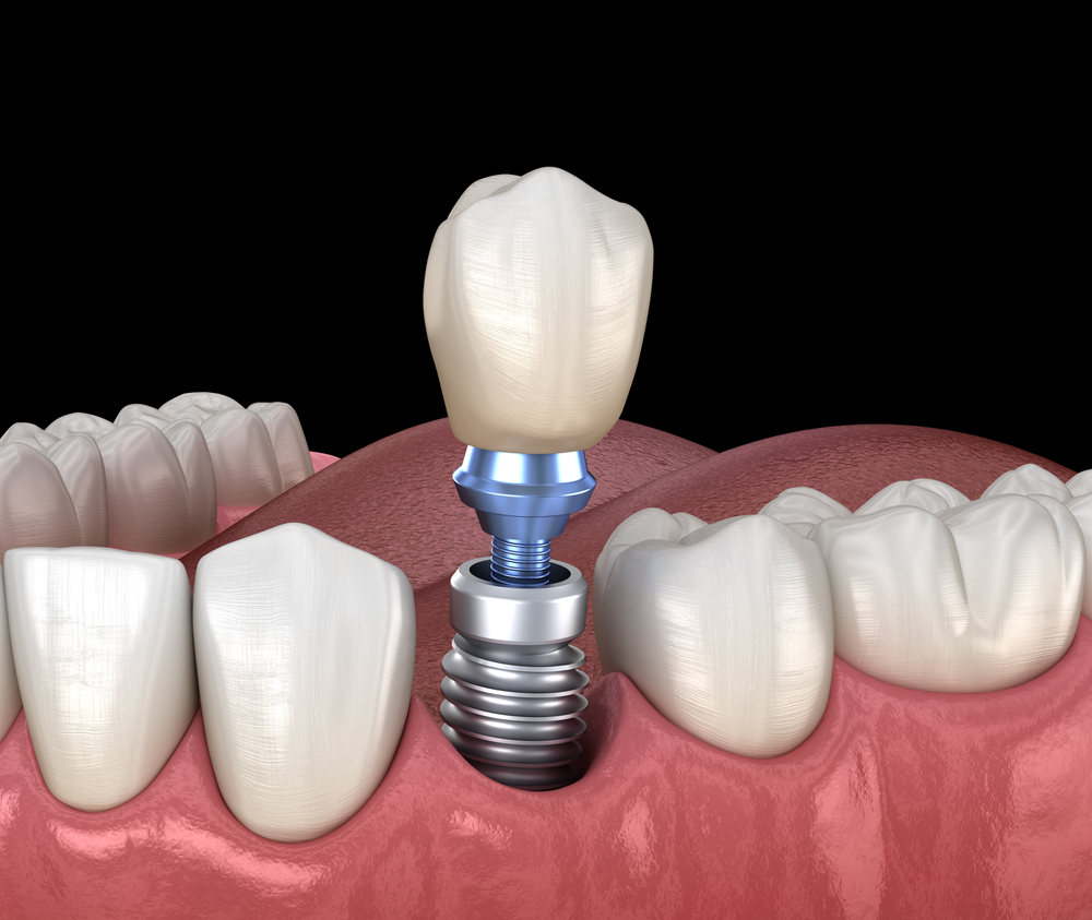 Implantes Dentários: Tudo o Que Precisa Saber Sobre Este Tratamento